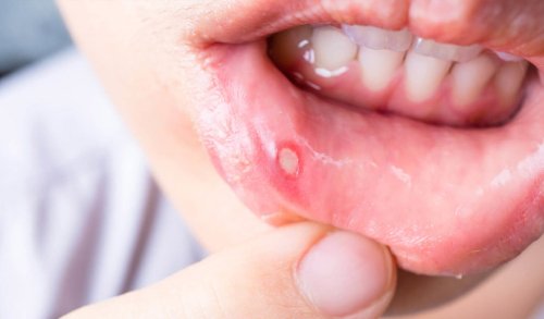infecciones en la boca