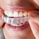 Invisalign Over