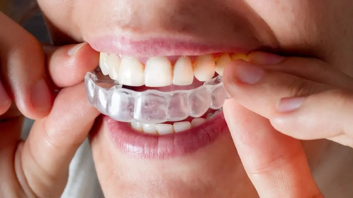 Invisalign Over